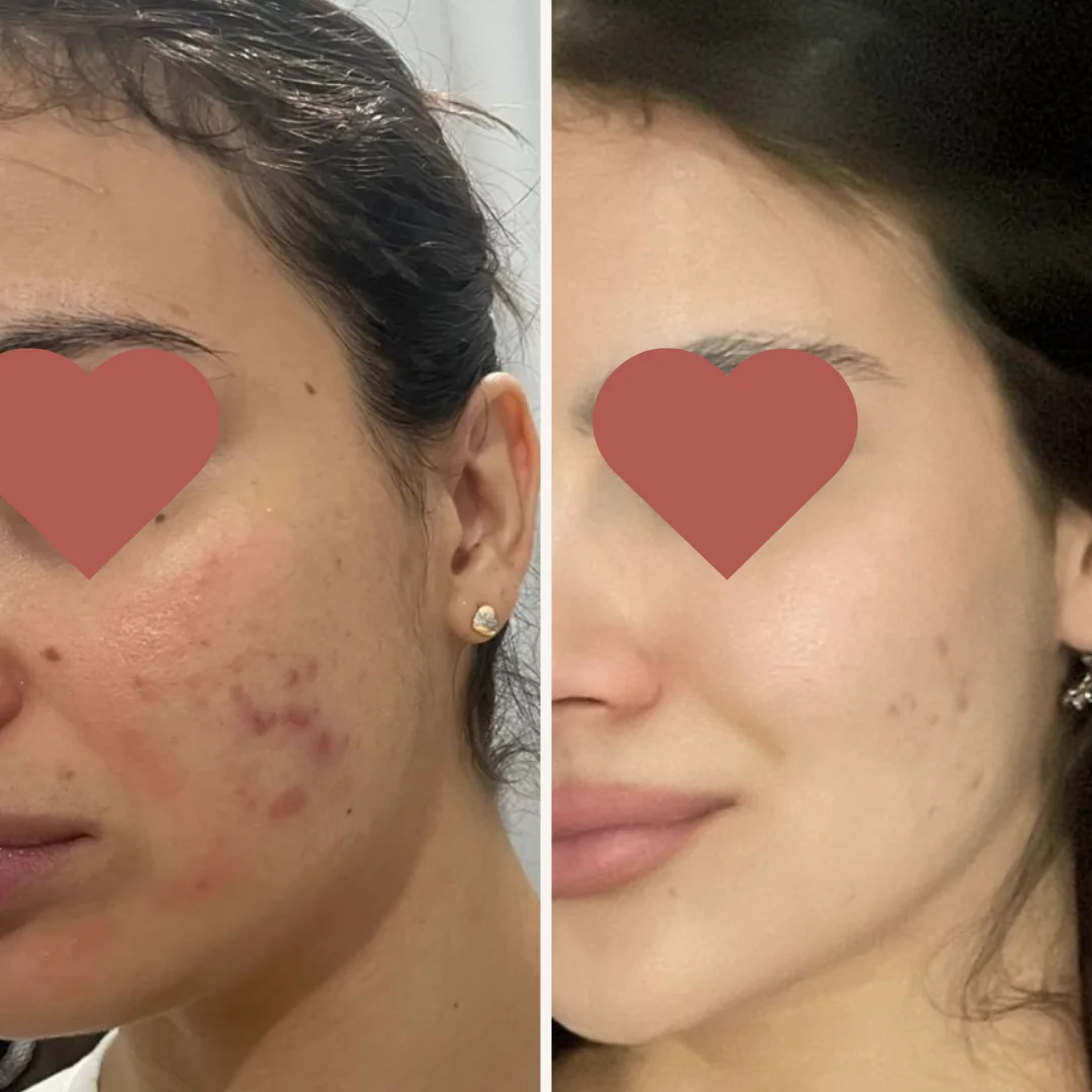 Resultado antes e depois do Método Livre de Acnes