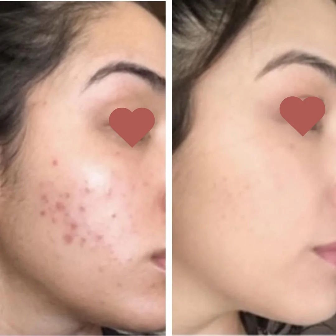Resultado antes e depois do Método Livre de Acnes