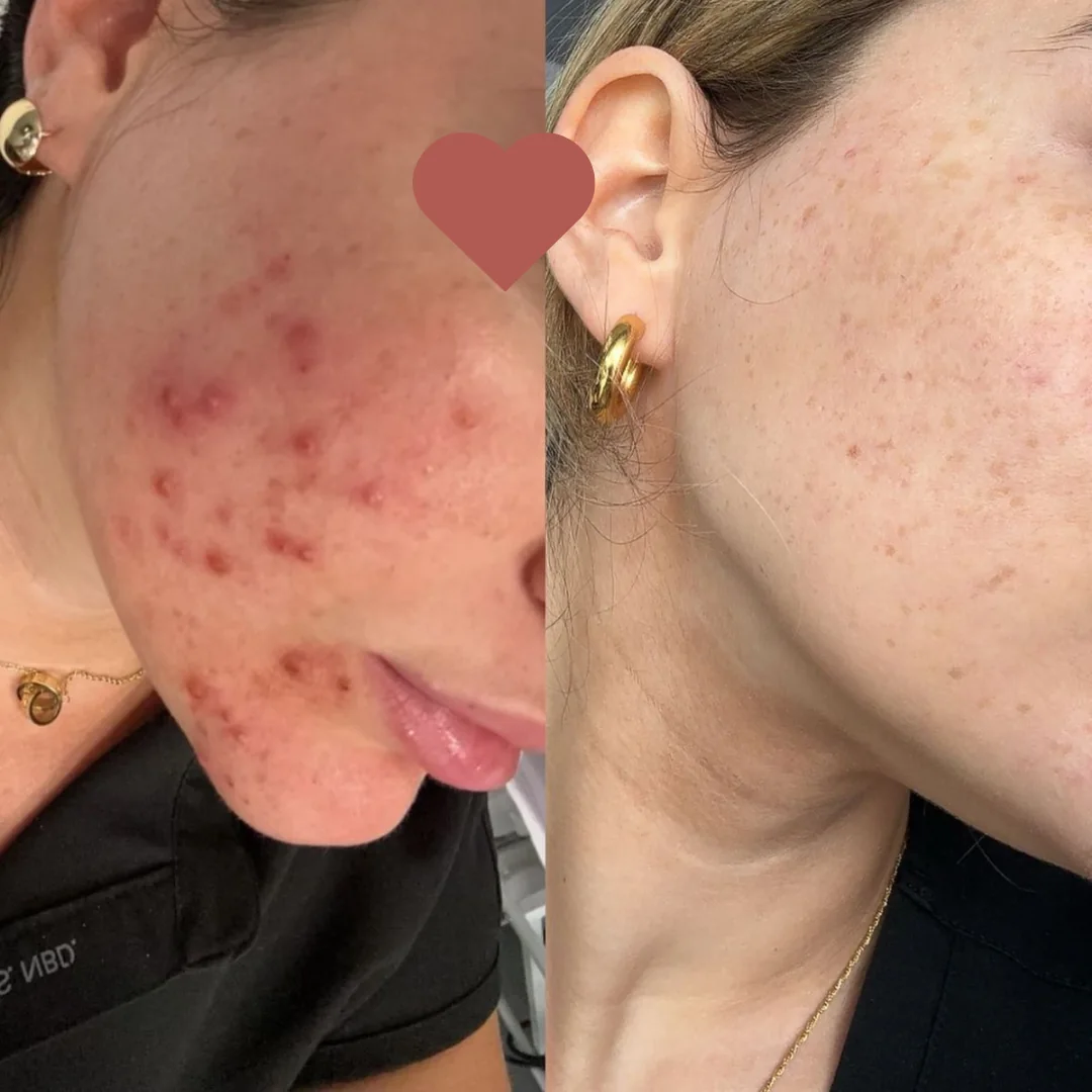 Resultado antes e depois do Método Livre de Acnes