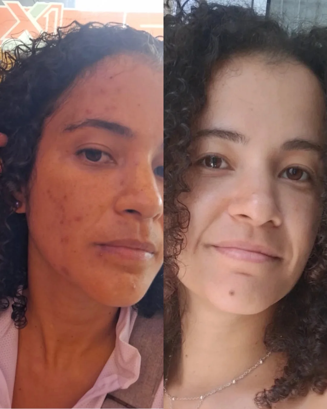 Resultado antes e depois do Método Livre de Acnes